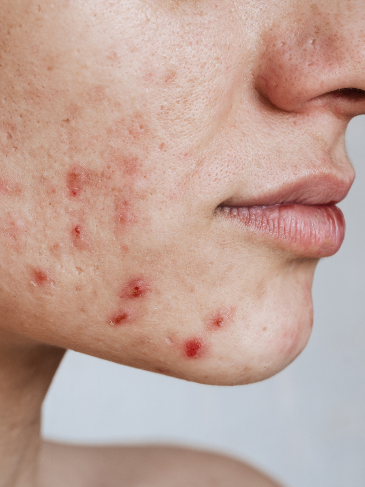 Acne e Brufoli: Tutto quello che devi sapere