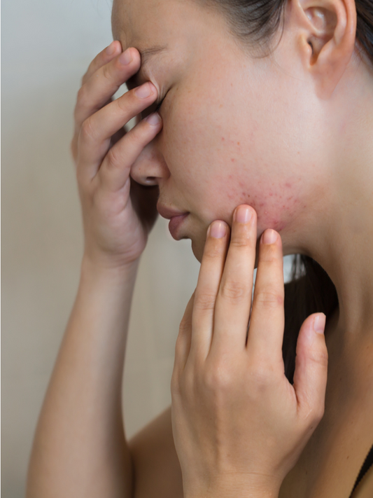 Stress e Acne: quando le emozioni si riflettono sulla pelle