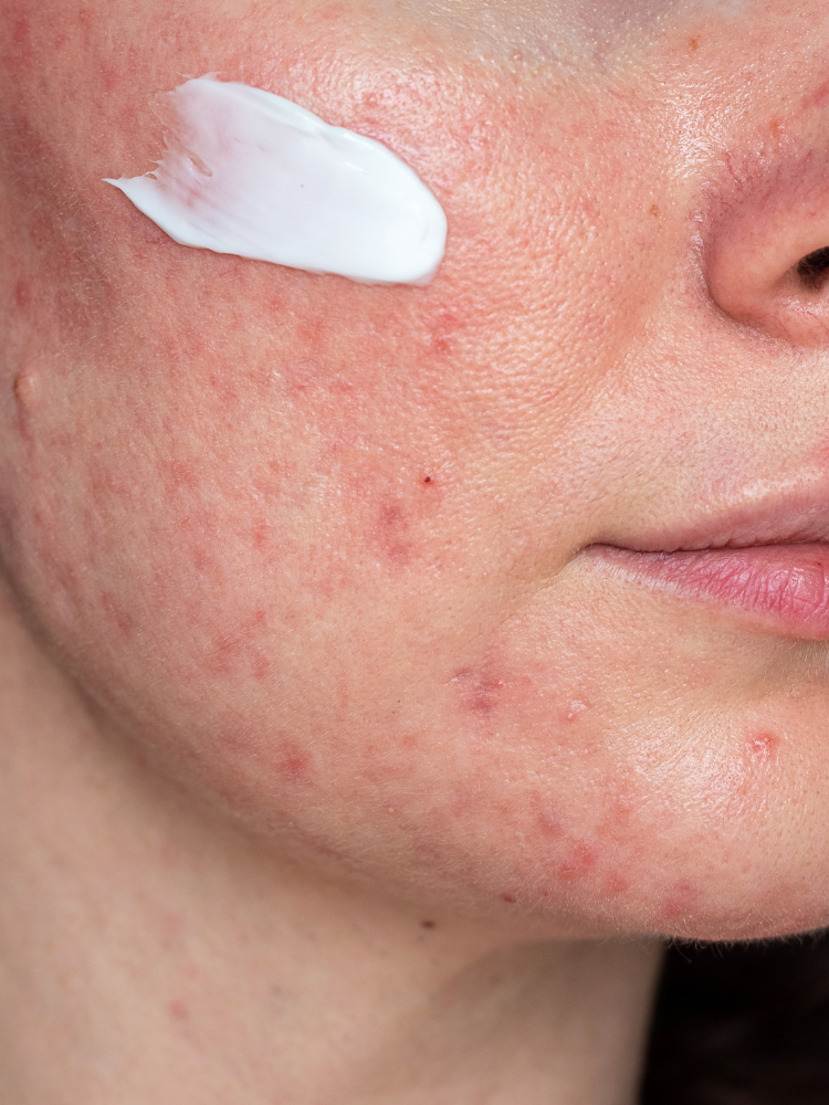 Skincare per Pelle con Rosacea: 5 consigli e quali prodotti da utilizzare