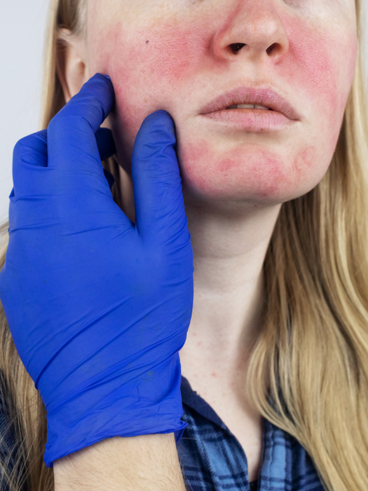 Rosacea: i fattori scatenanti da conoscere e come gestirli