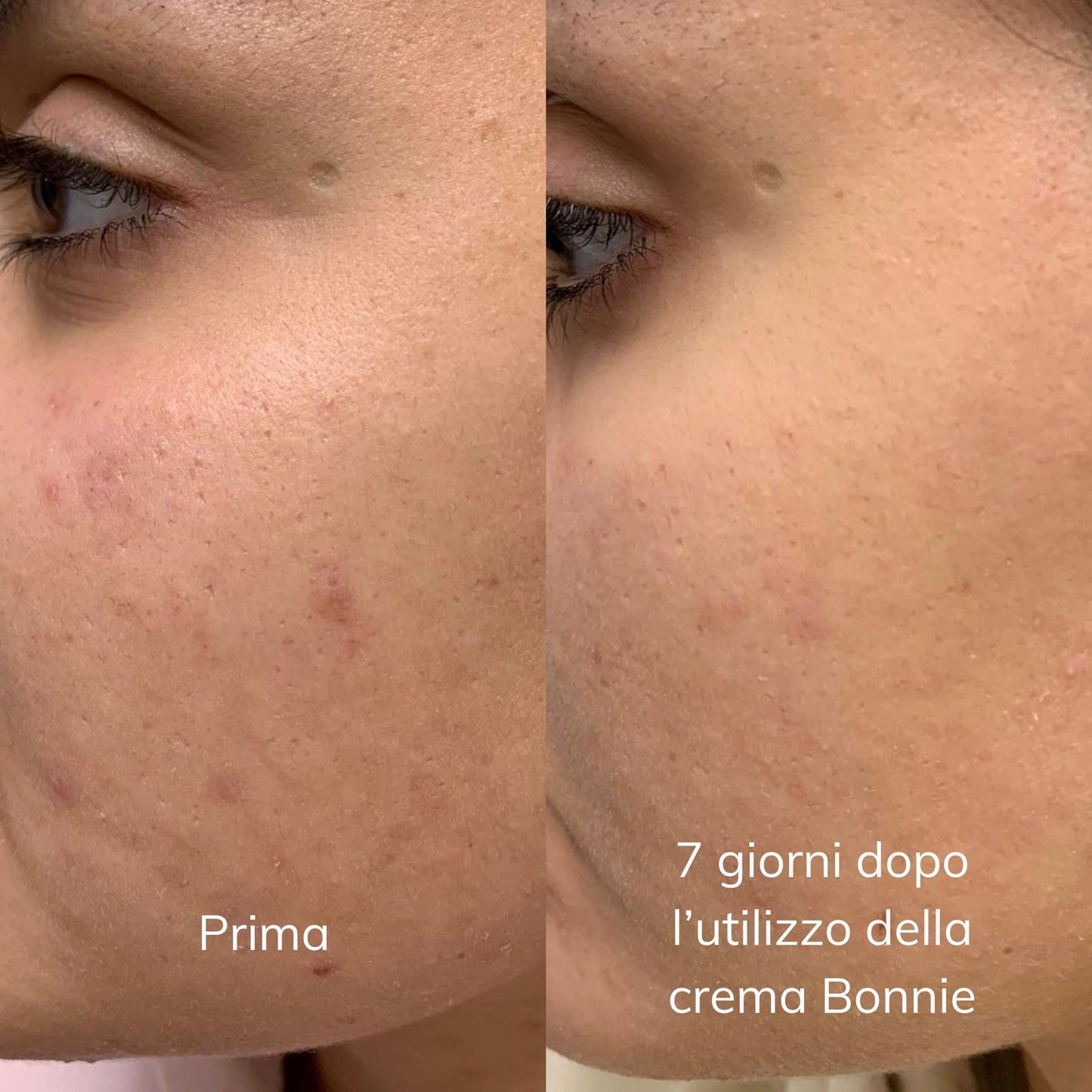Crema personalizzata Bonnie anti-acne